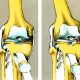 Συνδεσμικές κακώσεις έσω πλαγίου γόνατος