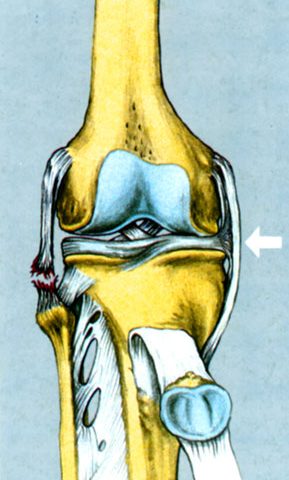 Συνδεσμικές κακώσεις έξω πλαγίου γόνατος
